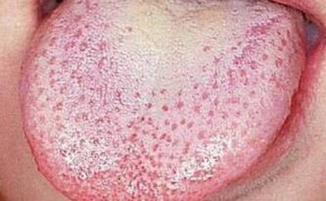 舌头上长白斑    口腔念珠菌病 舌头会出现白色,蓝白色丝绒状或凝乳状