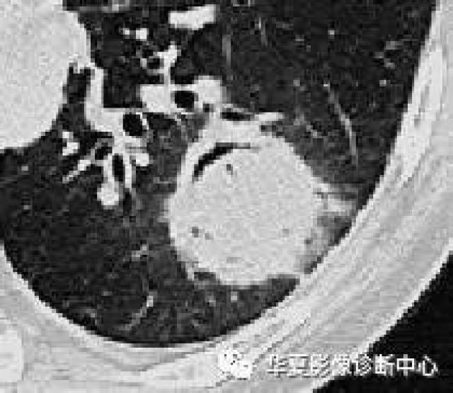 八,肺泡蛋白沉着征(pulmonary alveolar proteinosis pap)vc5影像园