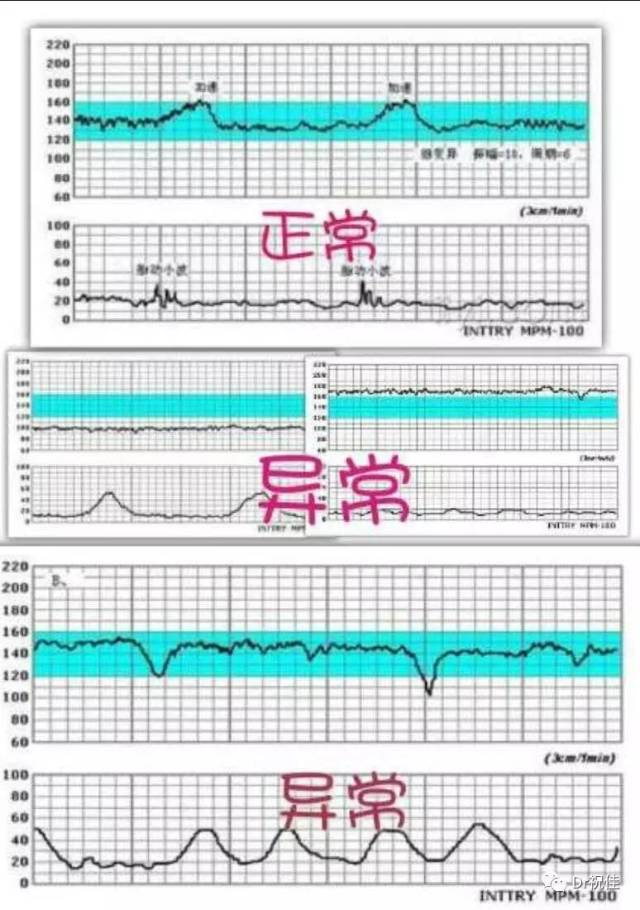 高危孕妇可以在28-30周开始),孕妈妈们就需要做胎心监护了