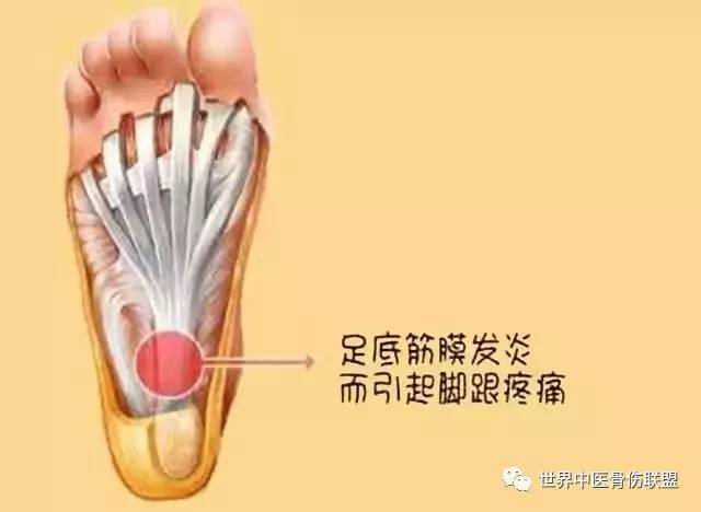 "足底筋膜炎"是引起我们足疼最常见的一种疾病,它是指足跟和足底部分