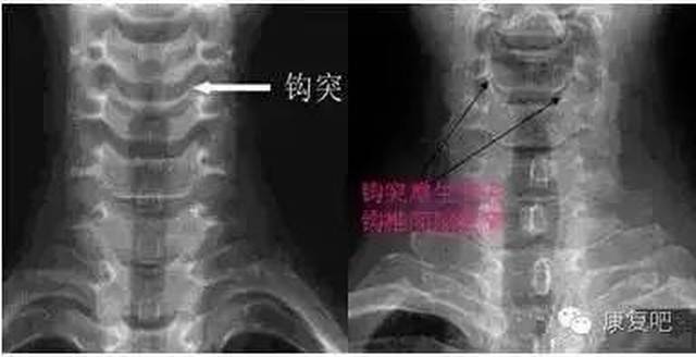 颈椎x线平片读片诊断口诀