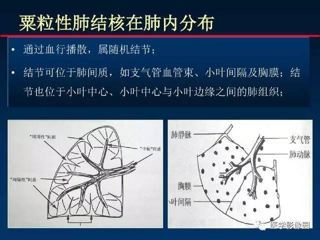 血行播散性肺结核的影像表现及鉴别诊断| 影像天地