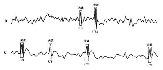 棘波和尖波就是鹤立鸡群,一看就比它们旁边的脑电波高,二者的区别最