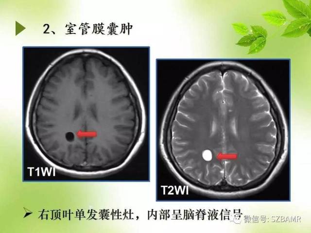 颅内神经上皮囊肿mri诊断与鉴别