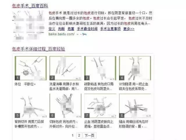 包皮手术在正规医院的价格大概就是几百块而已还随切随走不用住院,遇