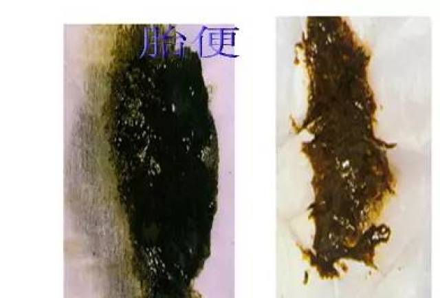 宝宝大便里偶尔会有少许白色颗粒,这是不消化的脂肪,不用担心.