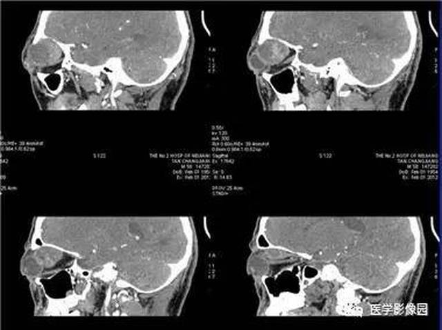 结果:眼眶腺样囊性癌 腺样囊性癌是泪腺恶性上皮性肿瘤中最常见的