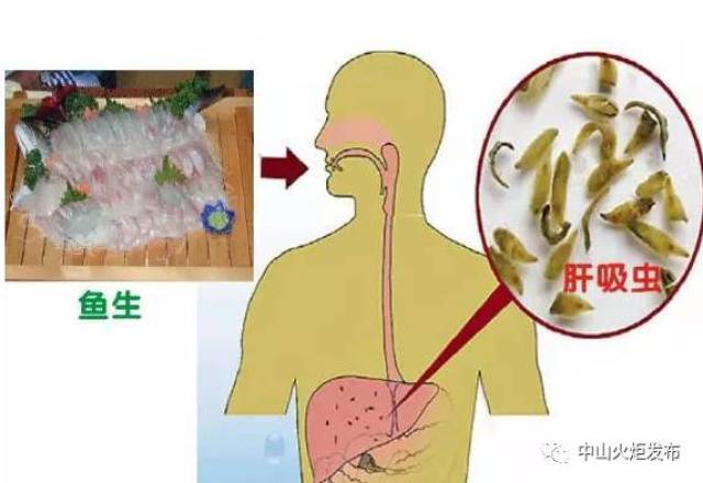 火炬区超两成人群感染肝吸虫,都是爱吃这种东西惹的祸!