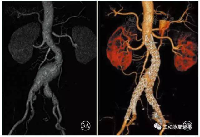 【医师视角】改良髂动脉分支支架腔内修复髂总动脉瘤的初步经验