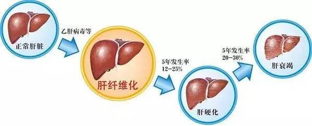 【片仔癀之友】肝衰竭短期内会肝坏死,肝衰竭三个阶段