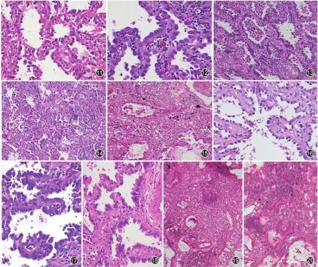 早期肺腺癌病理诊断若干问题