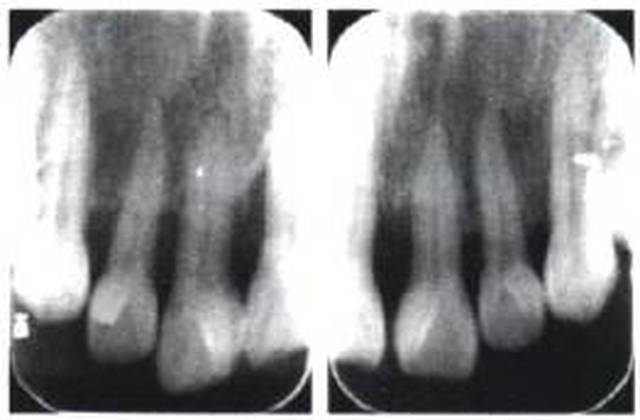 初诊时上前牙根尖片
