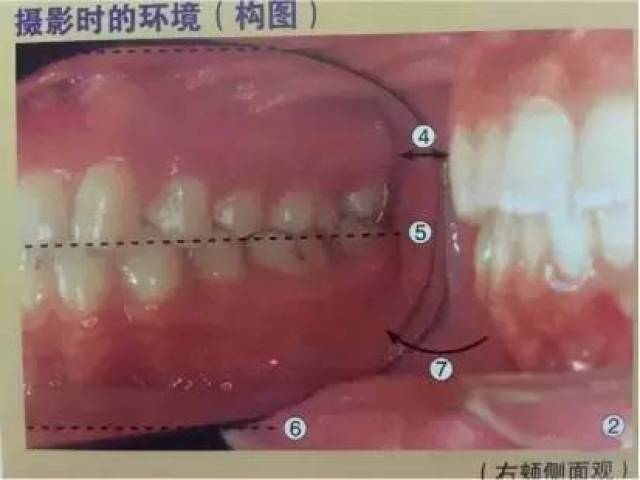 ③牙颈线位于反光板中央 ④反光板边缘与牙列平行 ⑤从正面对反光板