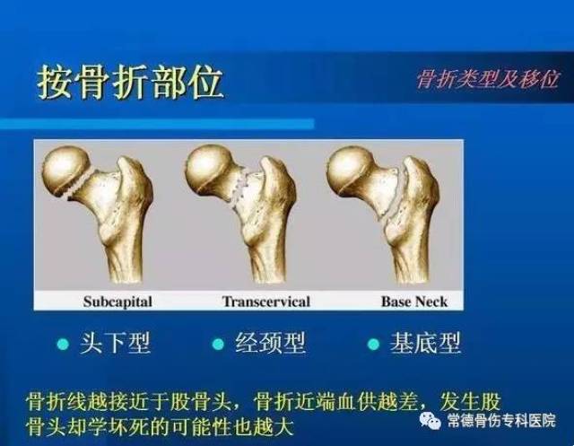 髋关节置换术治疗老年性股骨颈骨折临床疗效分析