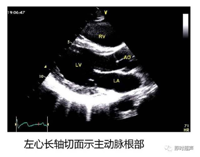 正常心脏超声解剖