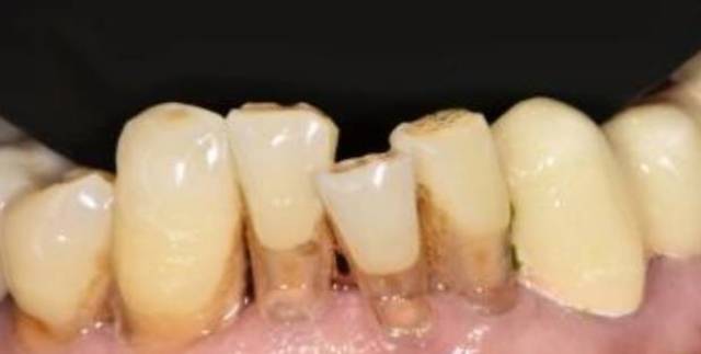 另一个常见的牙齿变黄原因 是牙釉质的磨损 磨损之后牙本质的颜色