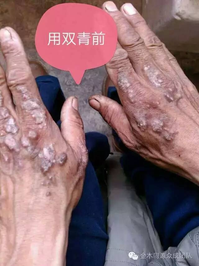 大人口周湿疹_婴儿湿疹图片(3)