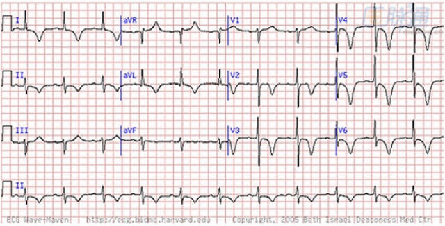 心肌梗死:不可错过的五种心电图线索,的确有用!