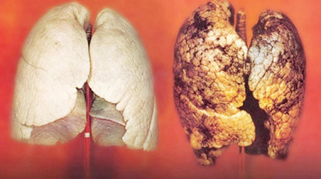 肺癌早期症状的6个表现,几分钟看完受益一生!