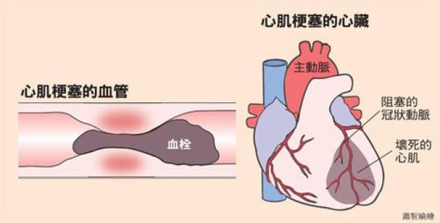 气短等现象或症状加重,并有逐渐加重的趋势时,需要警惕是心梗的发生