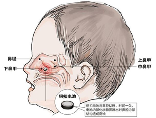 "已经腐烂,已造成鼻腔粘膜的严重腐蚀伤,鼻中隔穿孔.
