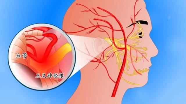 患者咨询:三叉神经痛,吃卡马西平无效,怎么办?