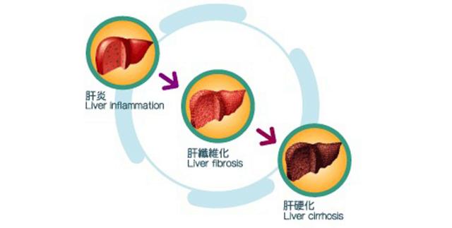 发病率最高的丙肝患者要怎样才能避免走向肝癌?