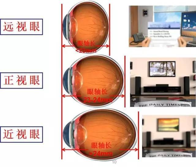 下面这几个近视常见问题,全球父母都在关注!