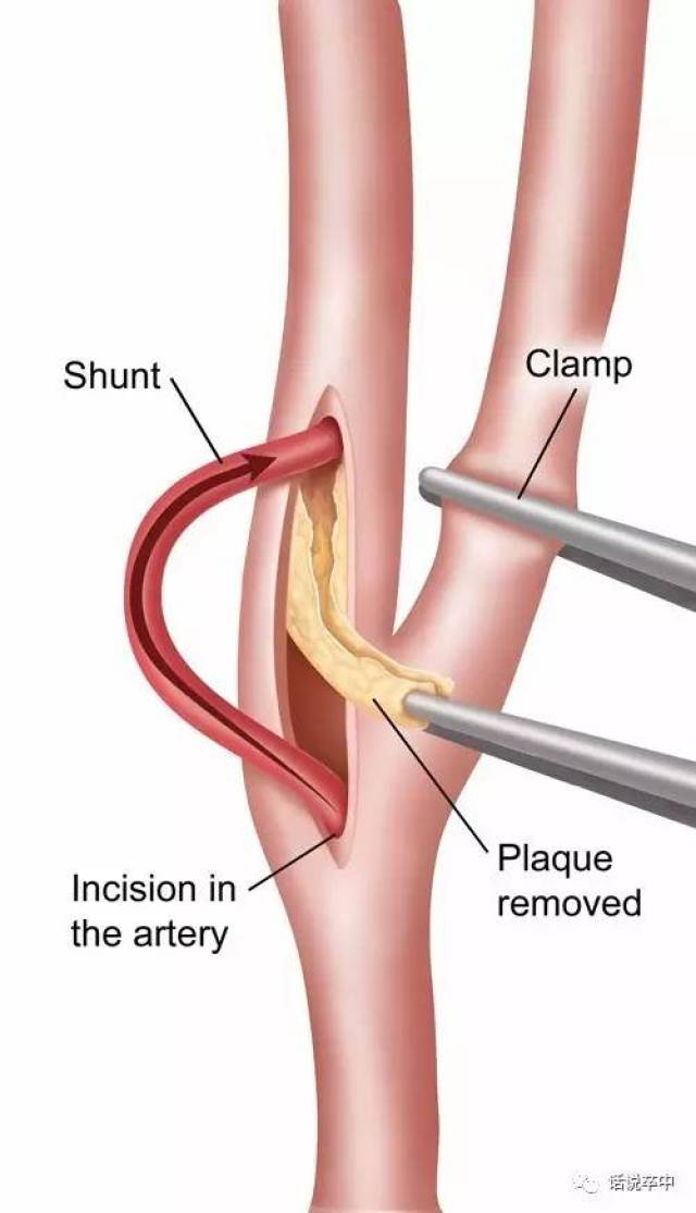 颈动脉斑块,取出还是放支架
