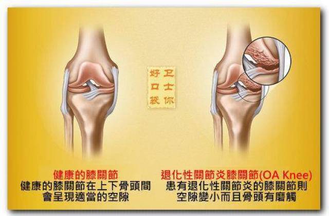 要重点考虑膝骨性关节炎!