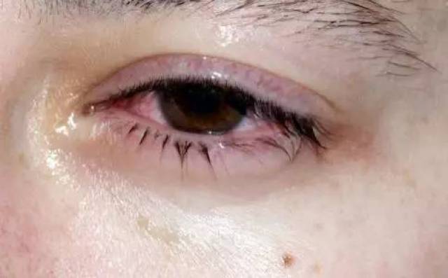 红眼病不能用普通消炎眼药水 如果一个人得了"红眼病",眼睛不舒服
