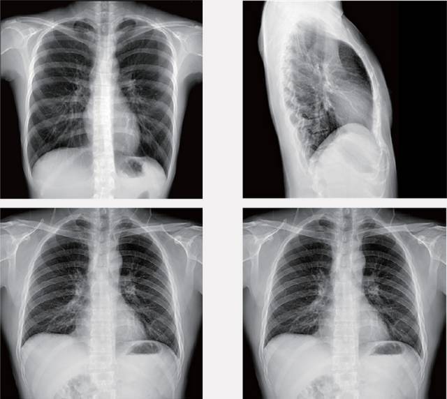 天地智慧 浅谈常规胸片在临床工作中的重要性-健康