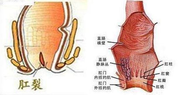 肛裂≠痔疮,3分钟学会准确鉴别和防治