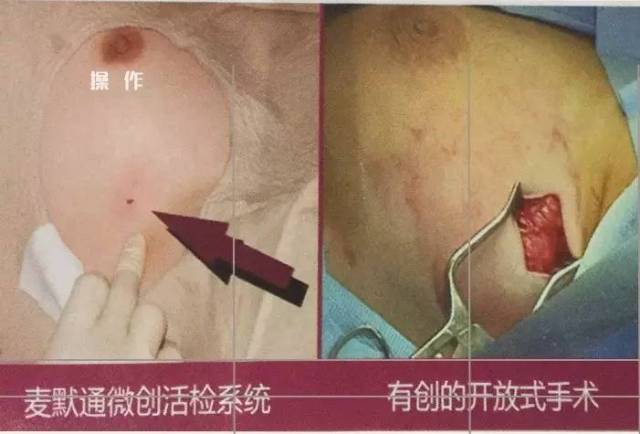 直径3cm以下的良性病灶切除如:纤维腺瘤,乳腺囊肿,乳腺结节,不典型性