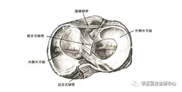 膝关节易误诊的正常解剖及伪影现象 一,膝横韧带: 连接内外侧半月板