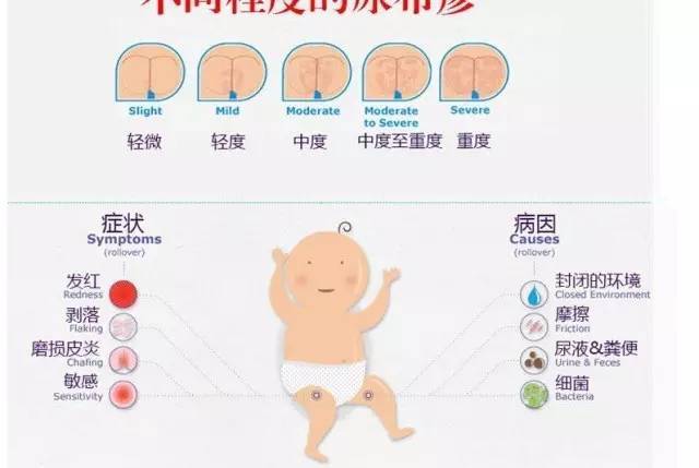 尿布疹是指宝宝在尿布覆盖部位出现的局部皮疹,常表现为皮肤发红,红色