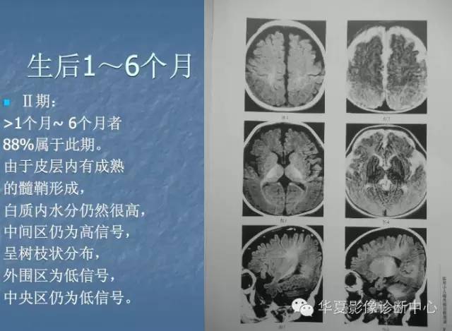 新生儿颅脑髓鞘化进程,您弄清了吗?