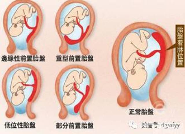 1,完全性前置胎盘:又称中央性前置胎盘,胎盘组织完全覆盖宫颈内口.