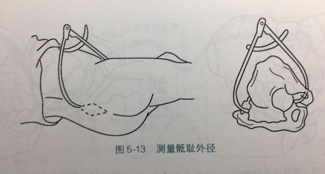 髂嵴间径(ic): 25-28cm,两髂嵴外缘的最宽距离 3.