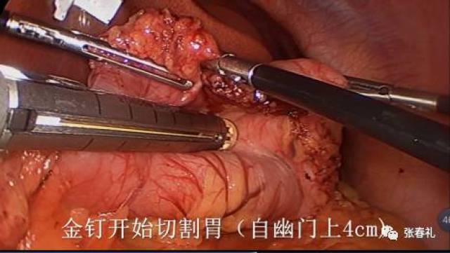 5分钟看懂:腹腔镜袖状胃减重手术