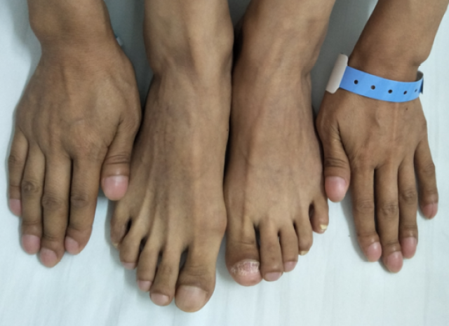 男子手指脚趾变形不重视!10个月后竟查出癌症?