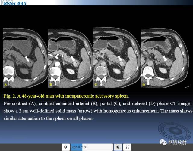 48岁男性,胰腺内副脾 直径约2cm,各期密度与脾脏一致.
