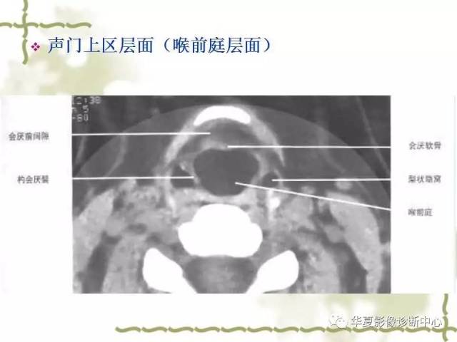 【影像基础】喉部解剖及各型喉癌的ct表现简记