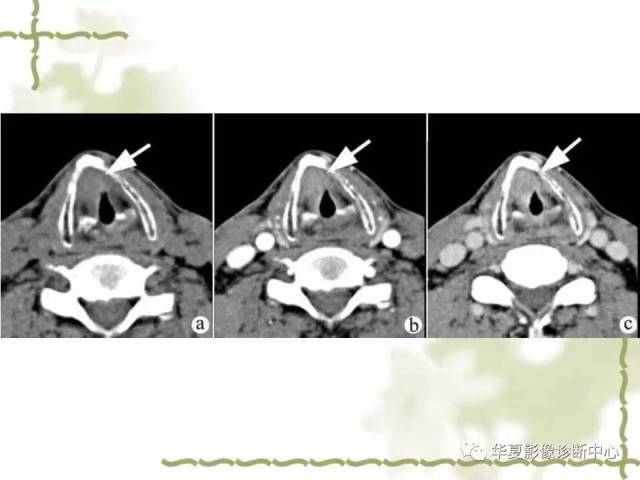 【影像基础】喉部解剖及各型喉癌的ct表现简记