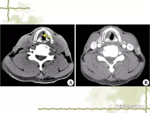 【影像基础】喉部解剖及各型喉癌的ct表现简记