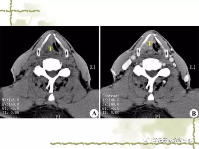 【影像基础】喉部解剖及各型喉癌的ct表现简记