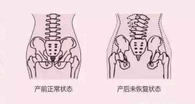 十个女人生完孩子十个盆骨都会打开,髋骨变宽.