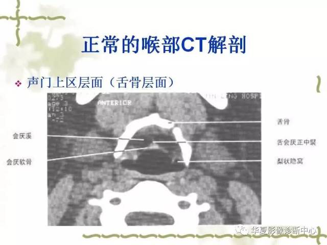 【影像基础】喉部解剖及各型喉癌的ct表现简记