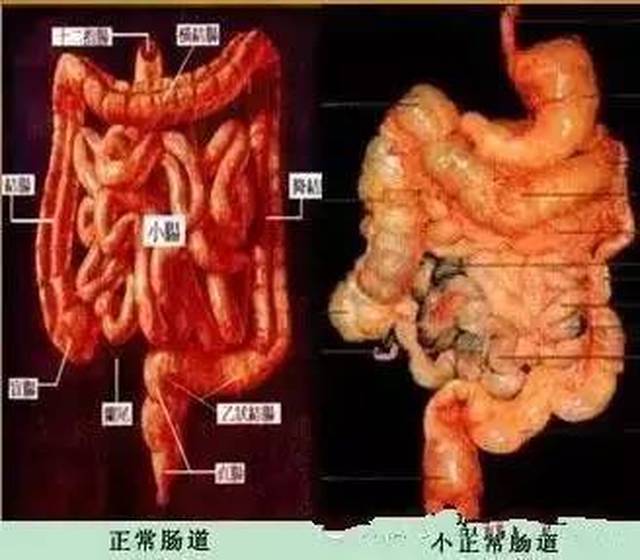 好细菌减少,肠道产生的毒素增加,保护能力下降,形象地说就是"肠子漏了