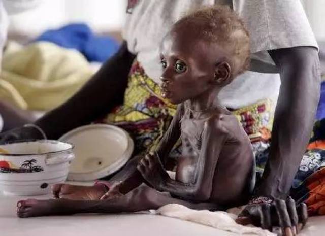 非洲难民儿童图片 非洲难民的饥饿儿童肚子为什么那么大?